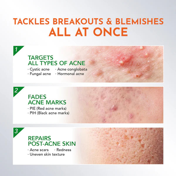 Y.O.U AcnePlus Spot Care Pro Serum 15g