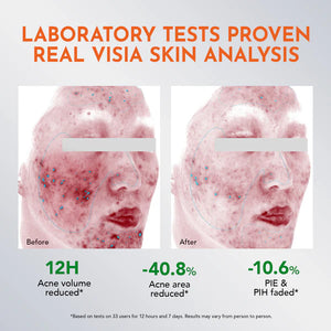 Y.O.U AcnePlus Spot Care Pro Serum 15g