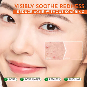 Y.O.U Acneplus 5X Acid Toner